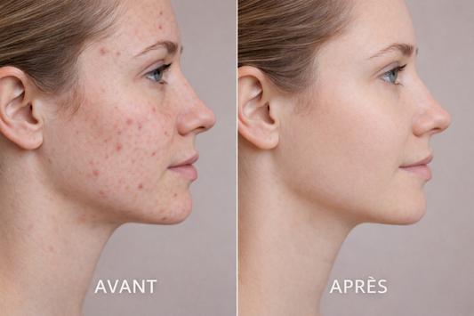 Huile de nigelle visage avant après